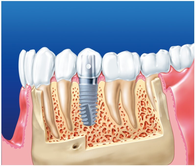 implantaciya2