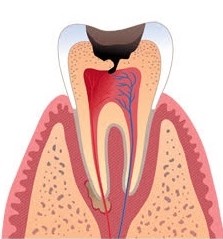 periodontit